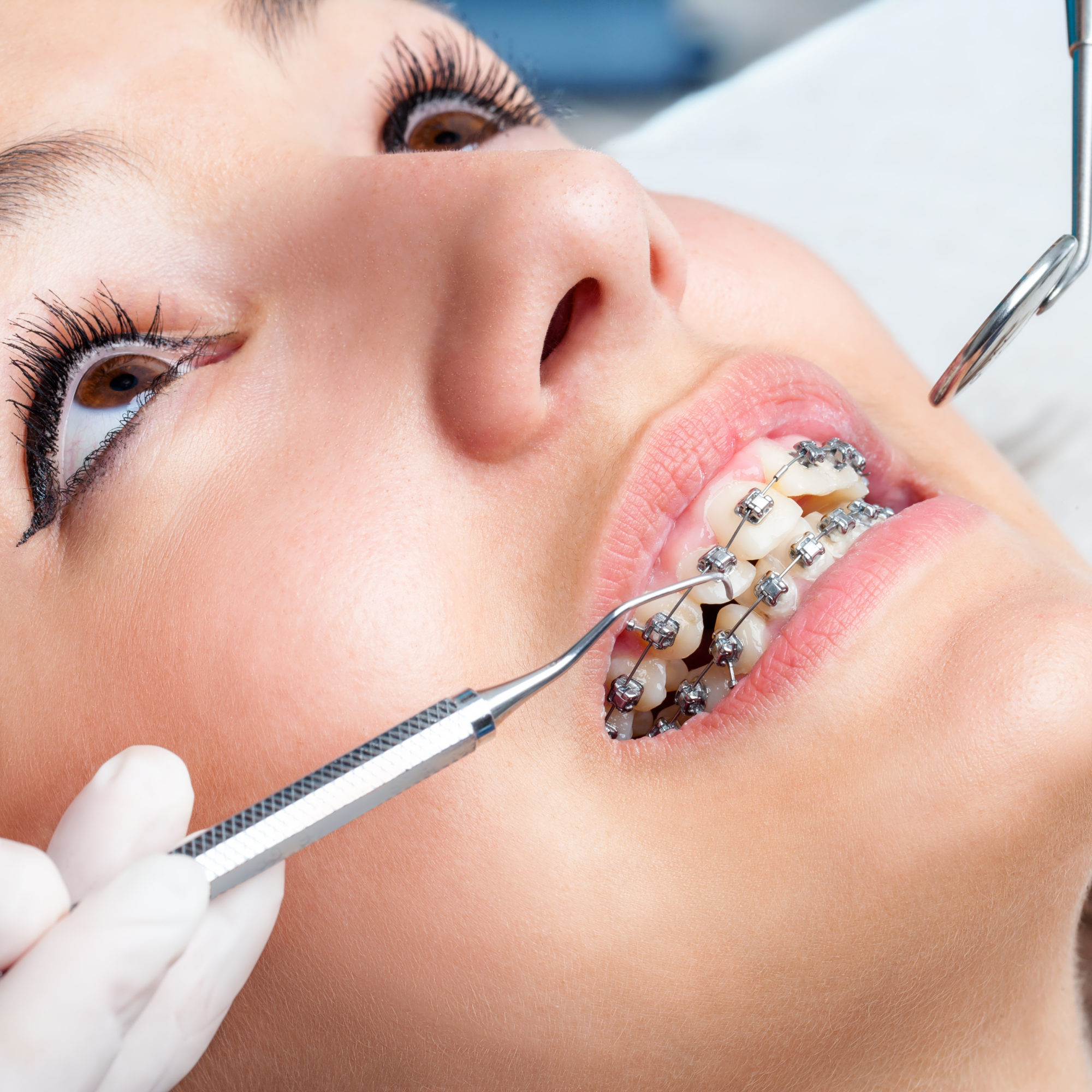 orthodontist-almere-orthomere-wij-bezorgen-u-de-mooiste-glimlach